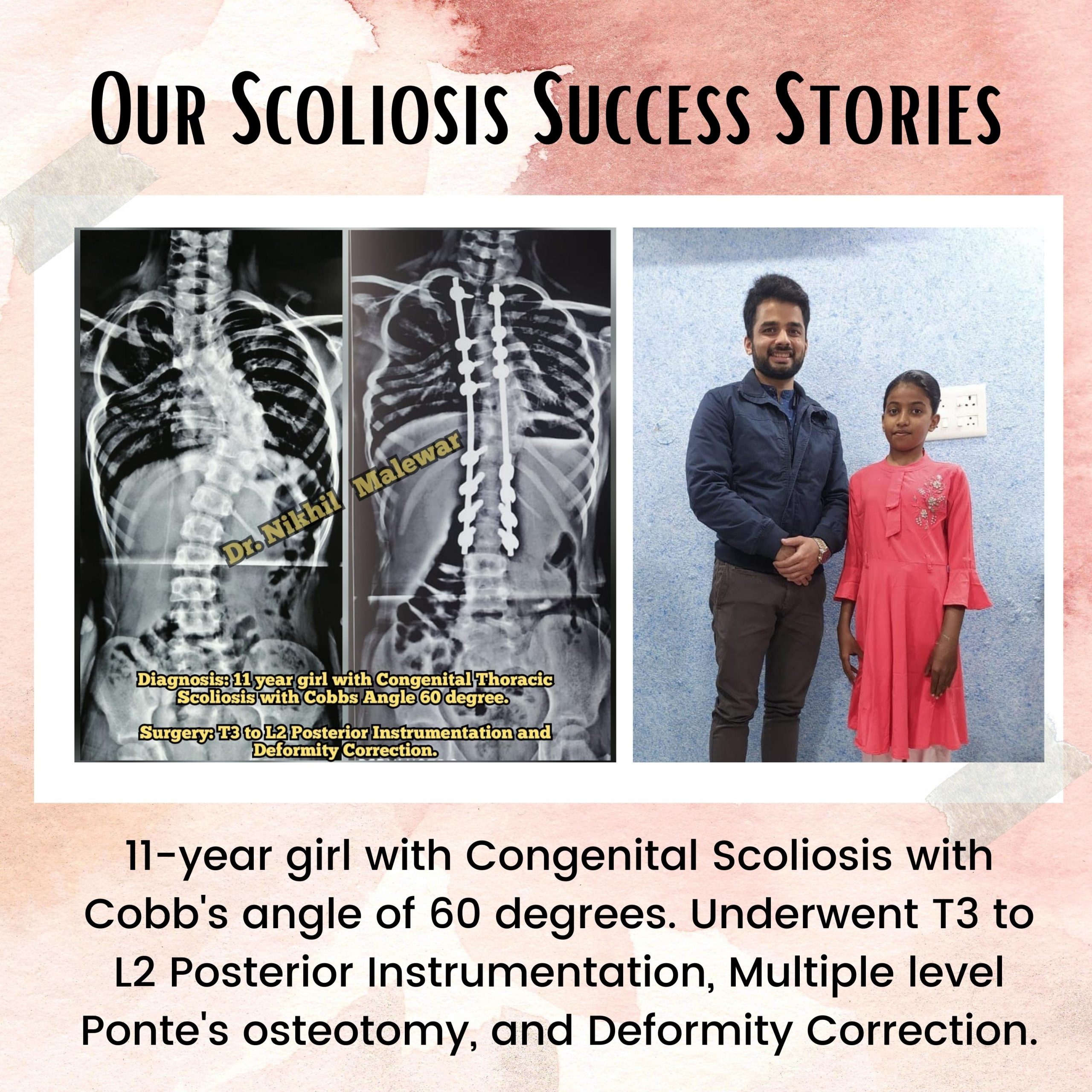 12 Our Scoliosis Success Stories