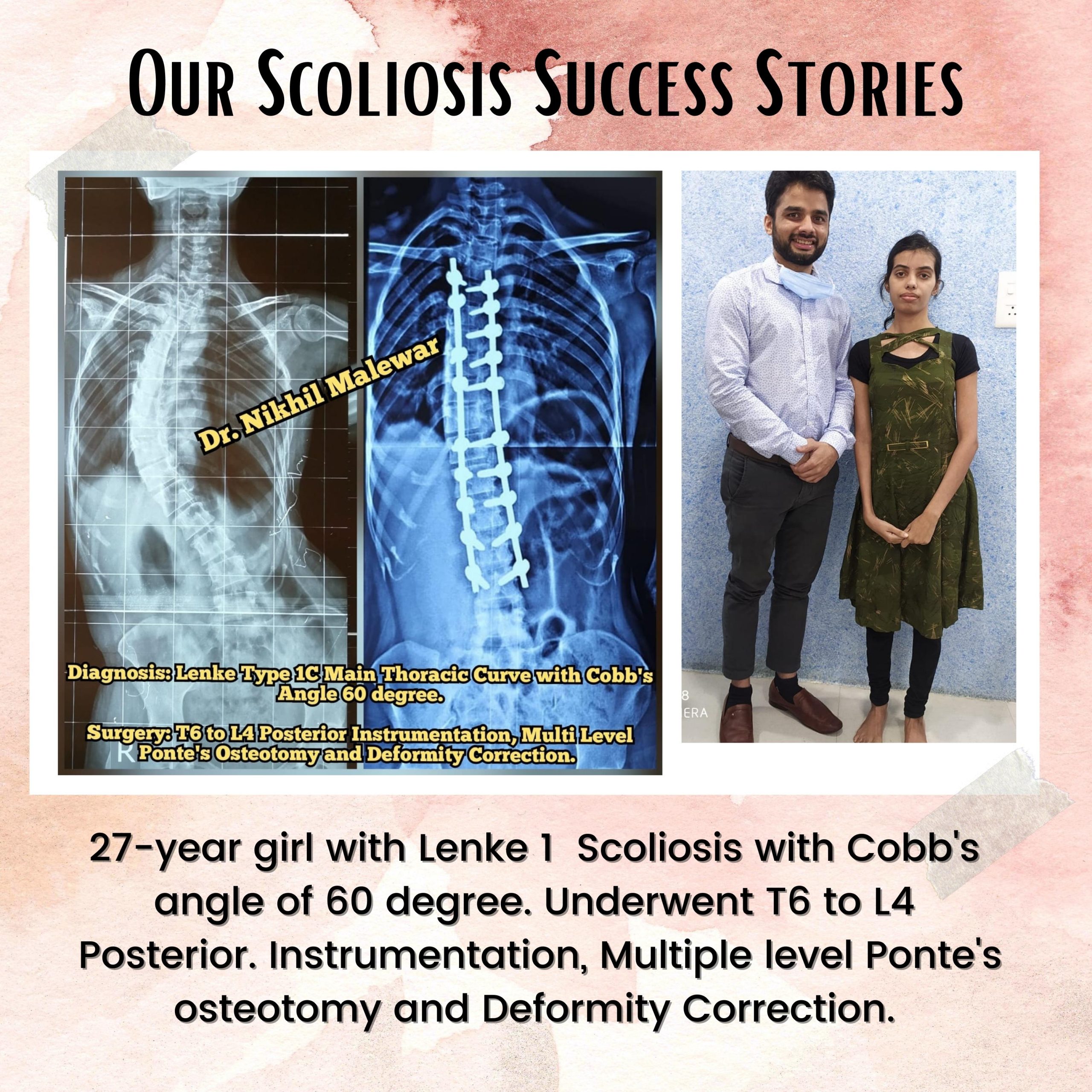 17 Our Scoliosis Success Stories