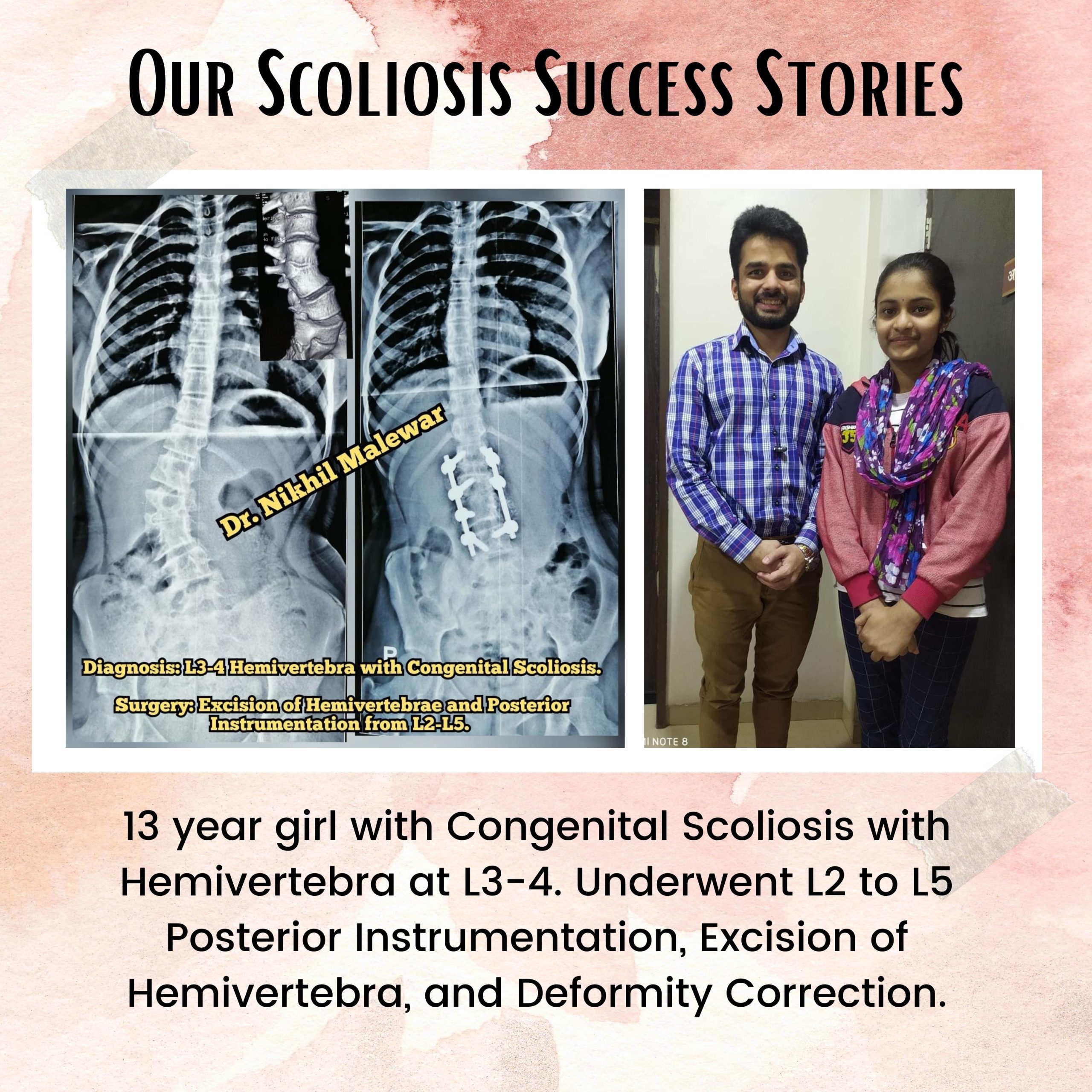 18 Our Scoliosis Success Stories