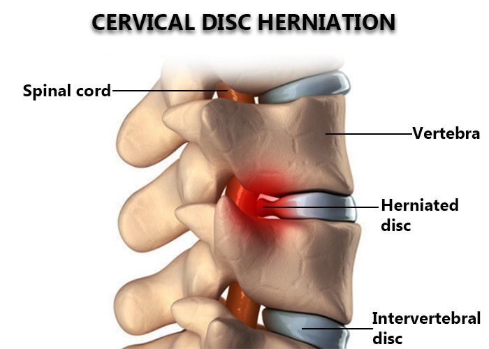 Cervical Slip Disc explain bone structure