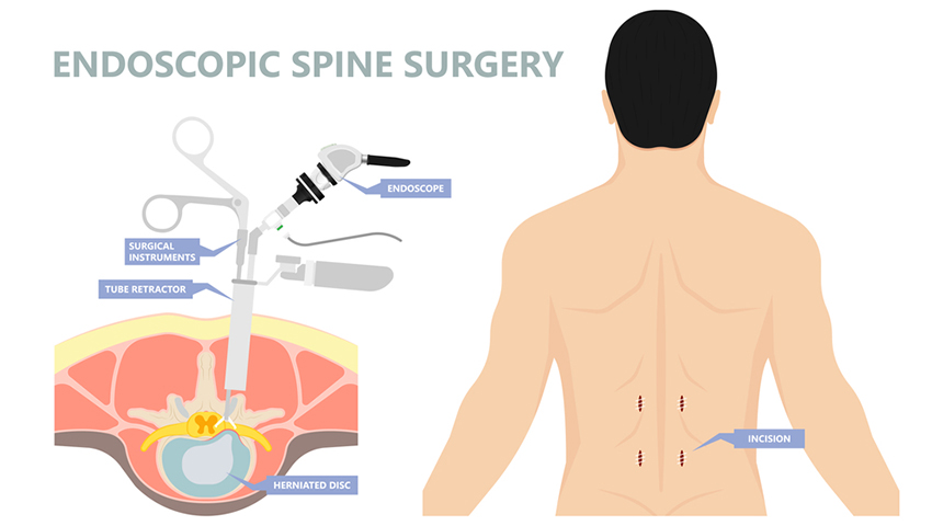 Endoscopic Spine Surgery incisor place shows