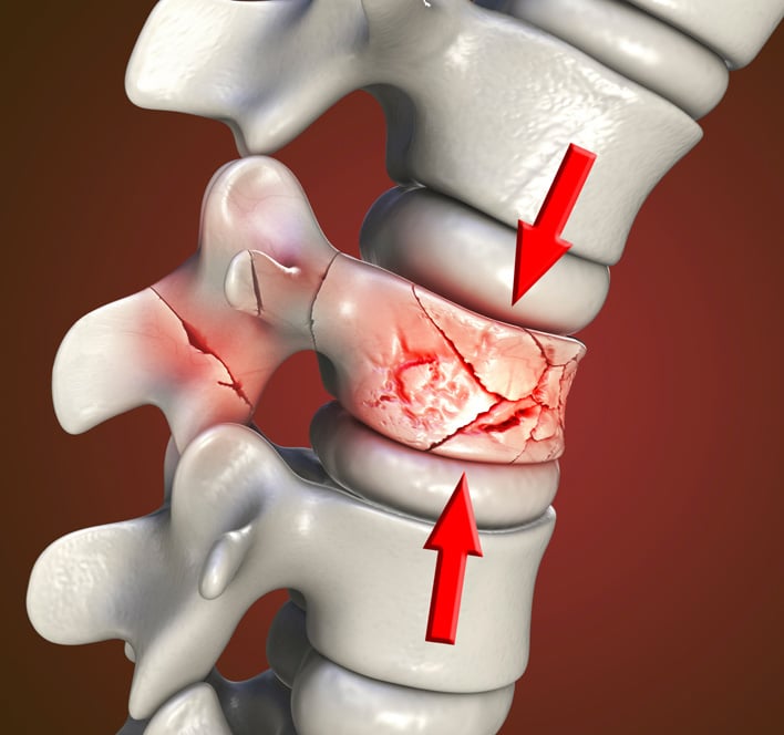 spine breaking Fracture shows