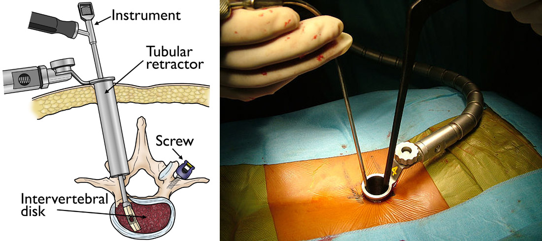 Minimally Invasive Spine Surgery patient spine hole checking treatment explain