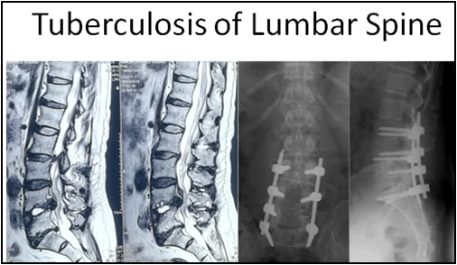 Tuberculosis Spine Surgery xray shows lumber spine