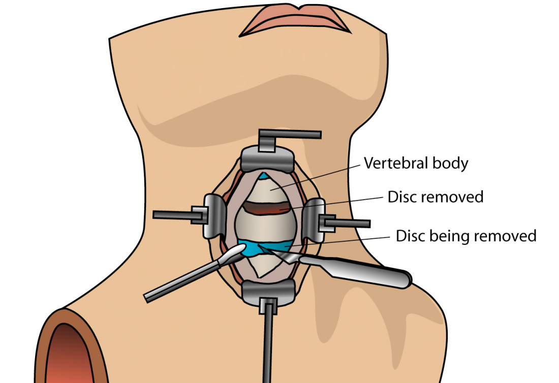 Anterior Cervical Discectomy & Fusion (ACDF) Surgery shows disk all parts