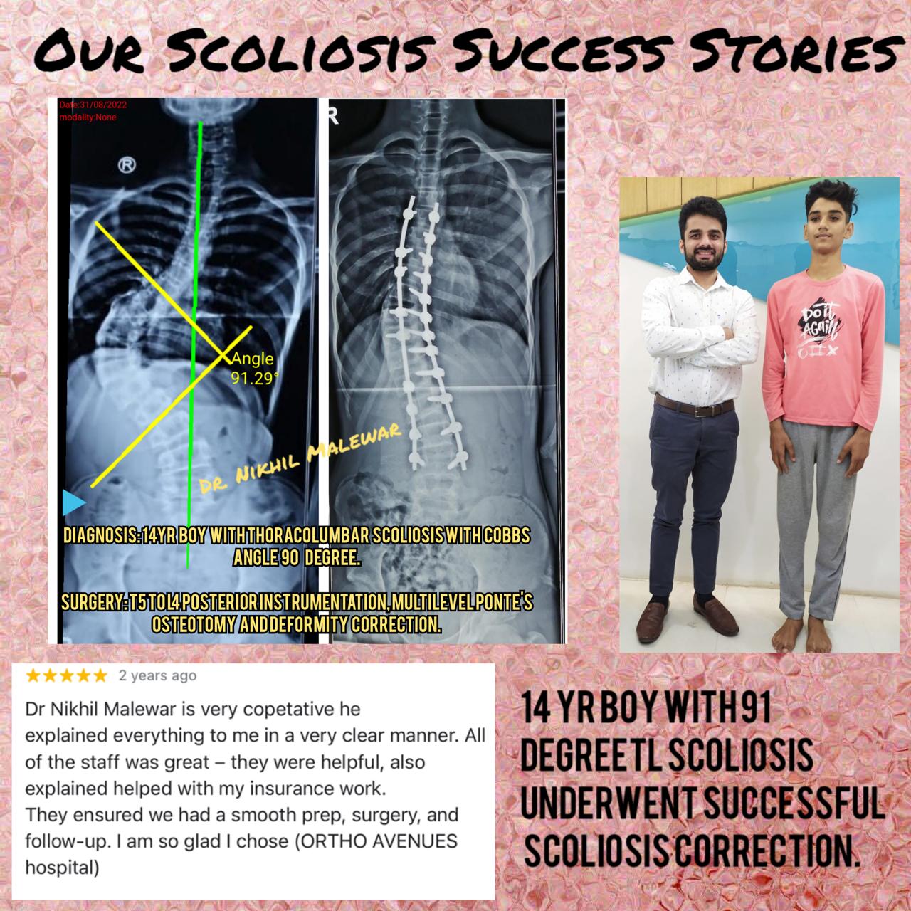 Our Scoliosis Success Stories (3)